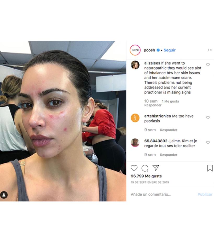 Kim Kardashian: con psoriasis